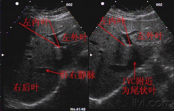 肝脏实习内容图片集 - 超声医学讨论版 - 爱爱医医学