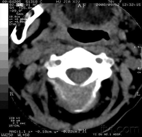 颈椎病例附xct图