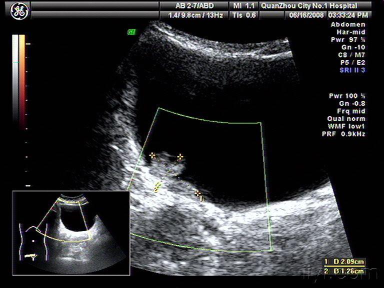 【讨论】膀胱癌的三维超声