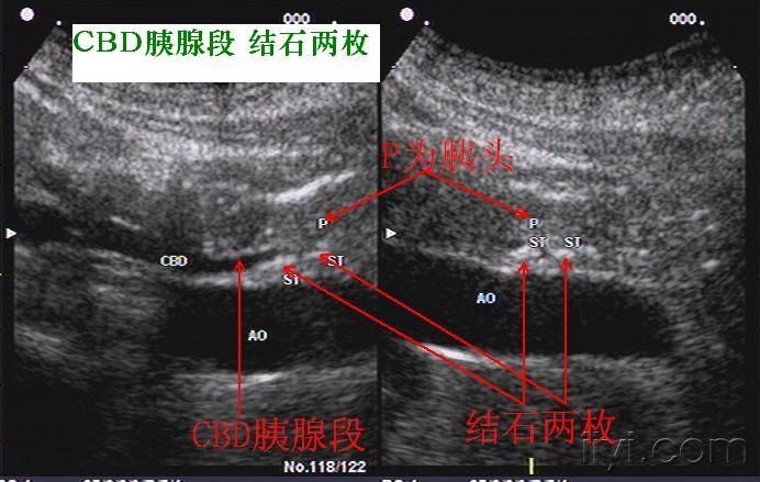 胆总管胰腺段结石两枚 - 超声医学讨论版 - 爱爱医