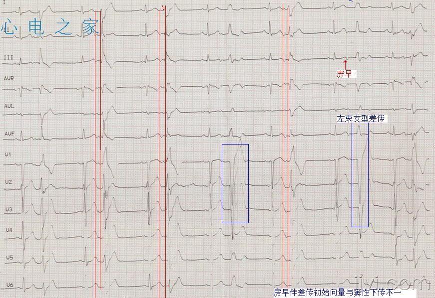 房早伴差传? - 心电图脑电图专业讨论版 - 爱爱医医学