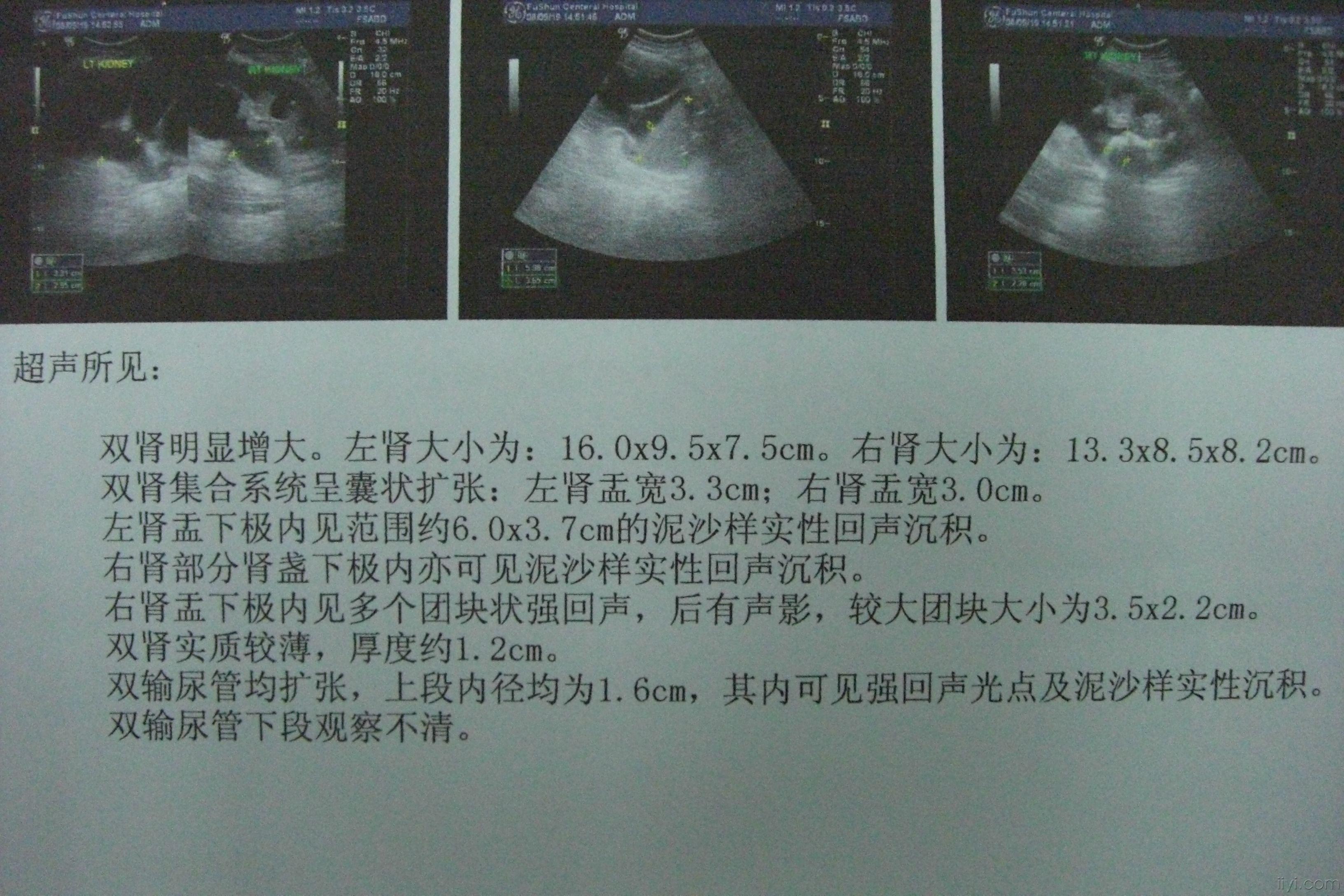 回肠膀胱术后输尿管狭窄并感染结石