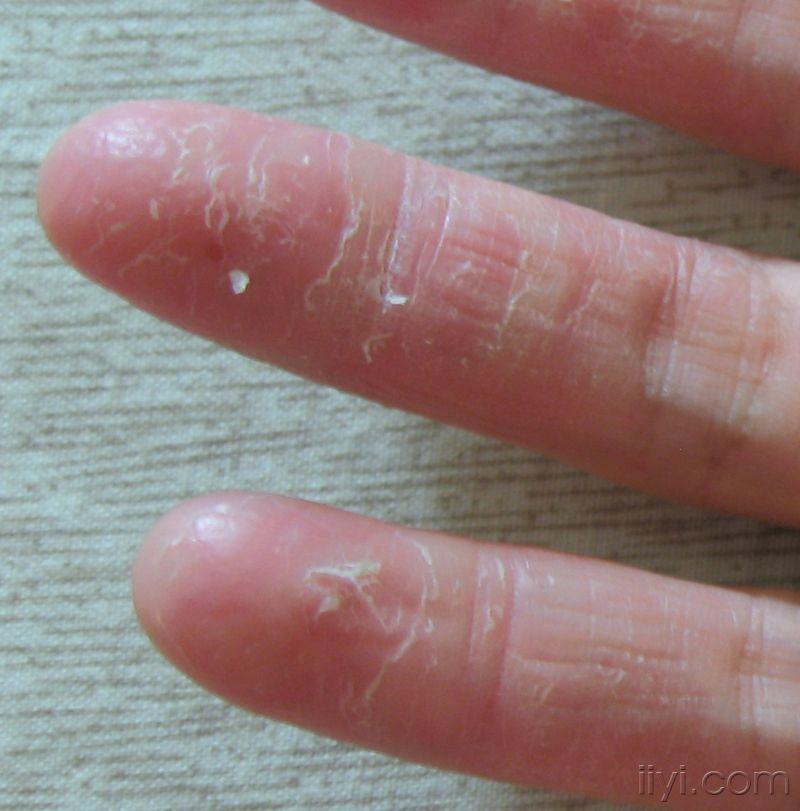 现患有"掌指角化症"一年余,重开始的一个手指到现在十个手指并逐渐