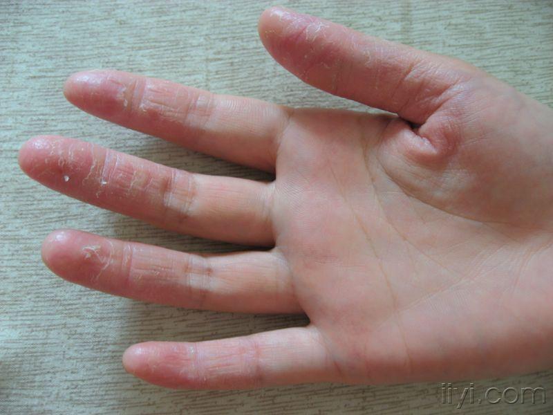 现患有"掌指角化症"一年余,重开始的一个手指到现在十个手指并逐渐