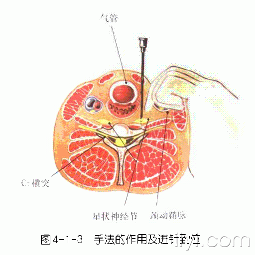 大家星状神经节阻滞都怎么做的?