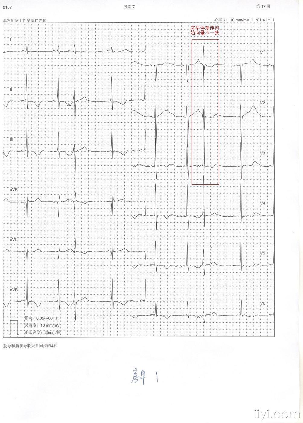 房早伴差传? - 心电图脑电图专业讨论版 - 爱爱医医学
