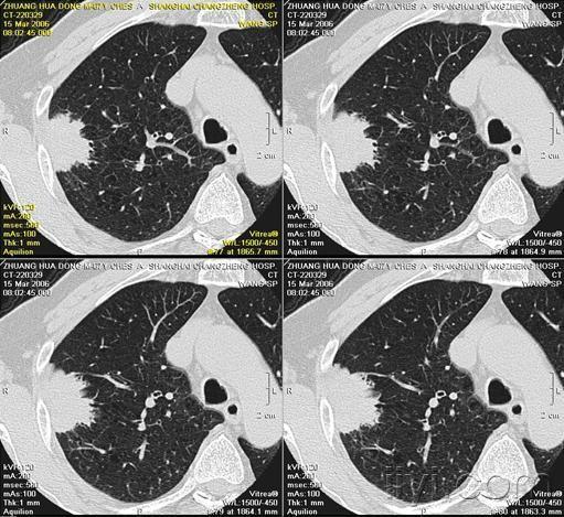 【专题】周围型肺癌ct影像征(病理基础,影像表现,鉴别