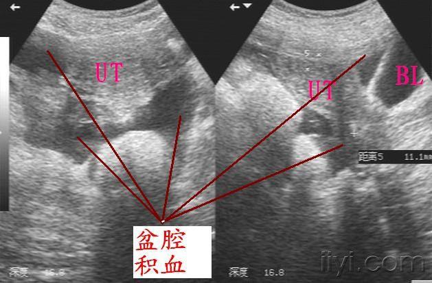 迟发性脾破裂(10月4日更正) - 超声医学讨论版 - 爱爱