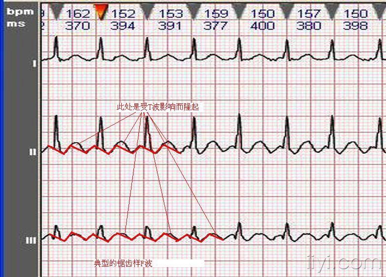 心电图学习20081003