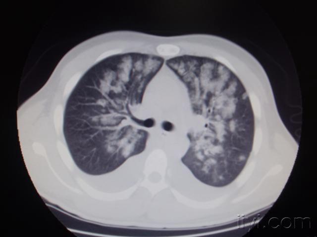 goodpasture综合征肺出血肾炎综合征平片ct