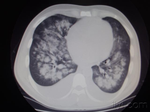 goodpasture综合征肺出血肾炎综合征平片ct