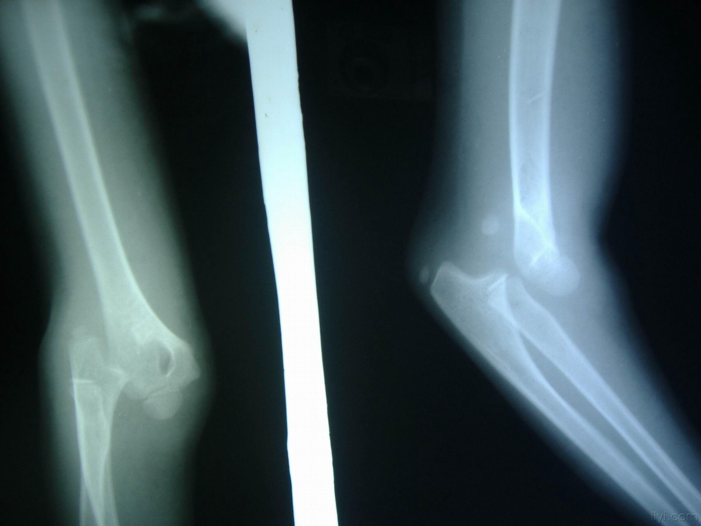 7岁小女孩肘关节后脱位肱骨内上髁骨骺分离复位后带图片