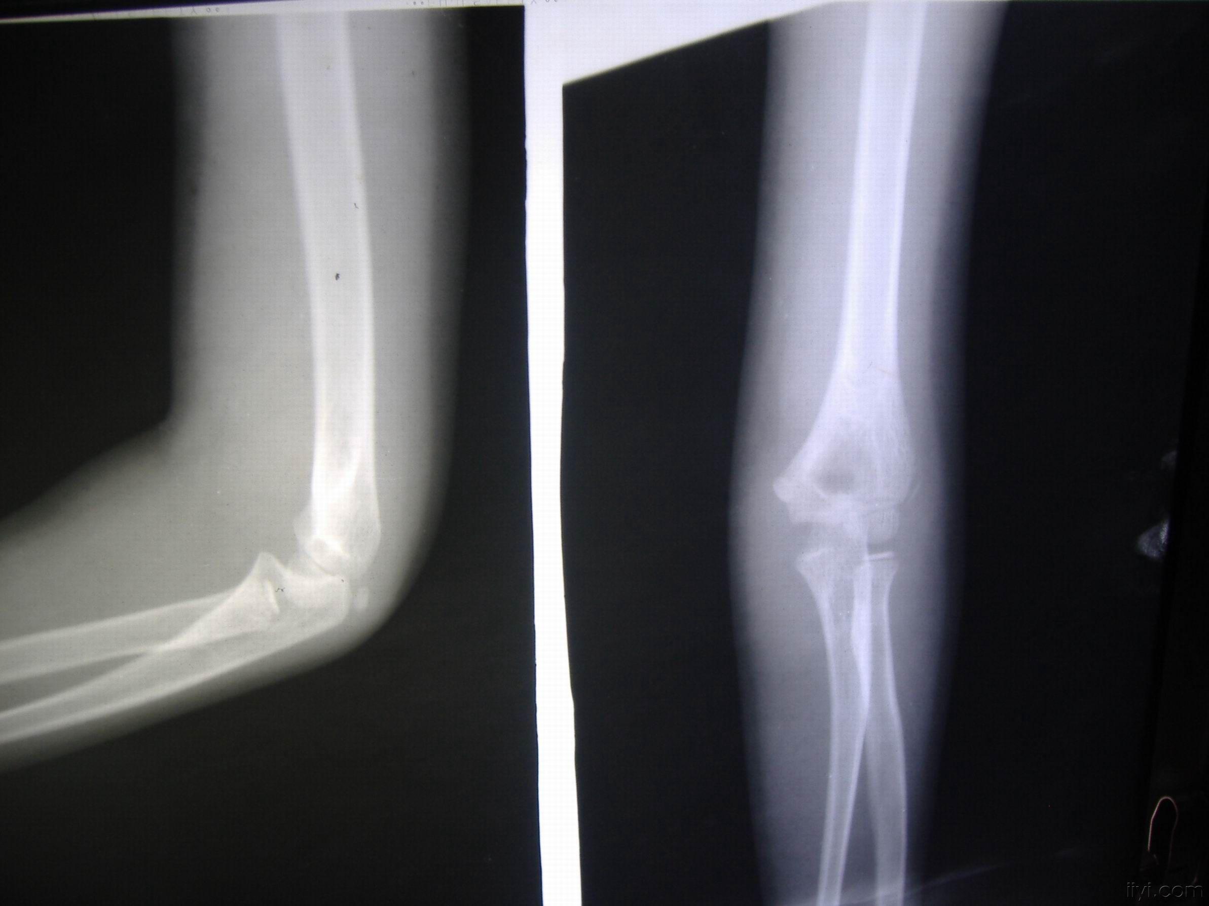 7岁小女孩肘关节后脱位,肱骨内上髁骨骺分离,复位后带图片