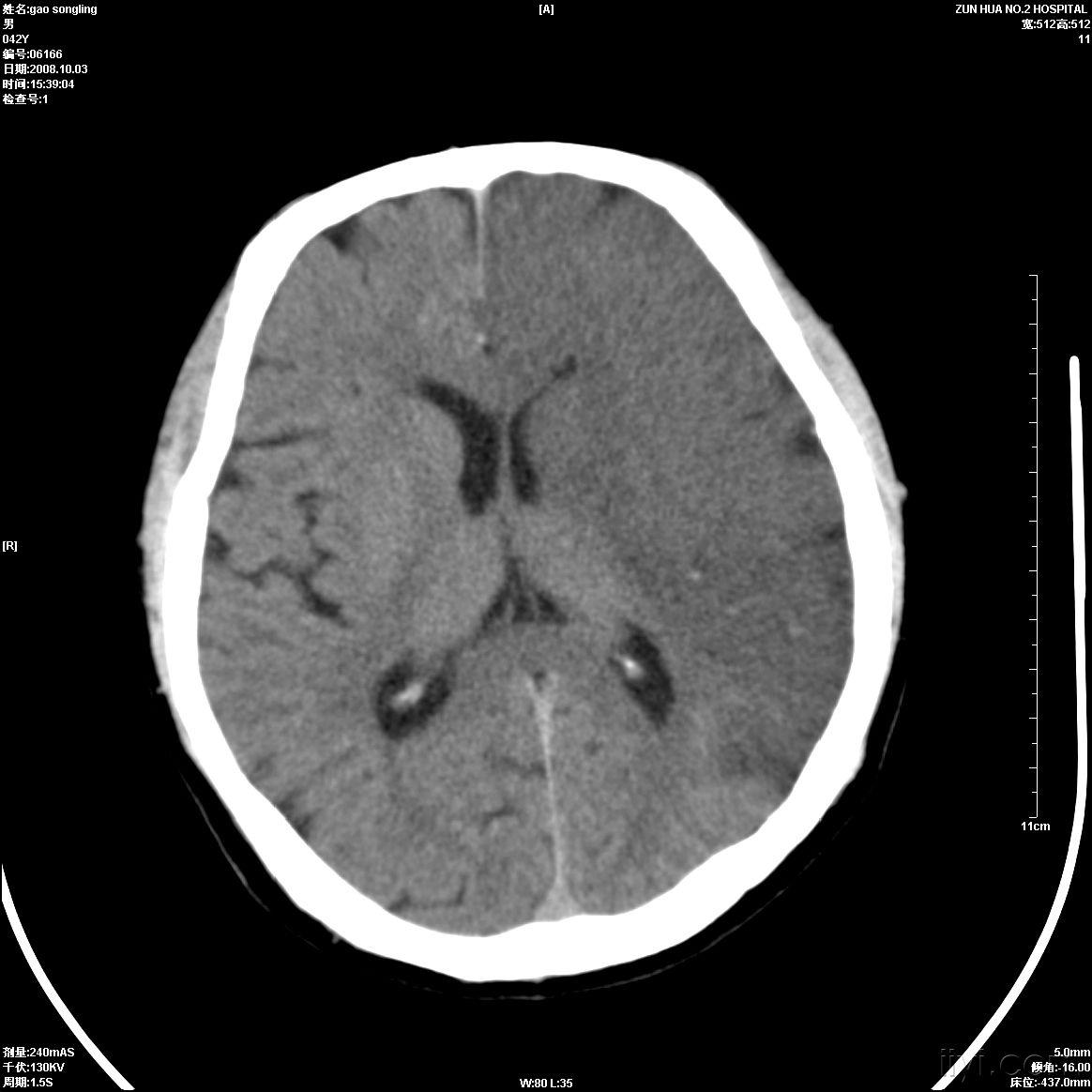左侧大脑中动脉供血区大面积脑梗塞