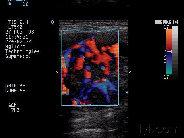 【贴图】颈动脉体瘤组图 超声医学讨论版 爱爱医医学论坛