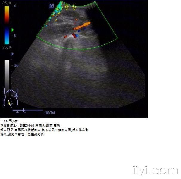 【贴图】典型阑尾炎并阑尾内粪石 - 超声医学讨论版