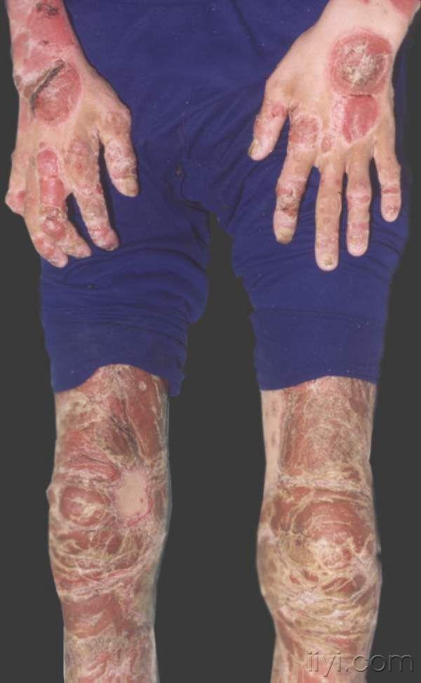 图9-11膝,手部关节炎型银屑病.jpg