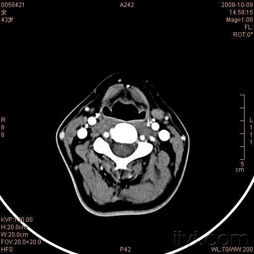 女,43岁,左颈后枕骨下肿物(ct mr)