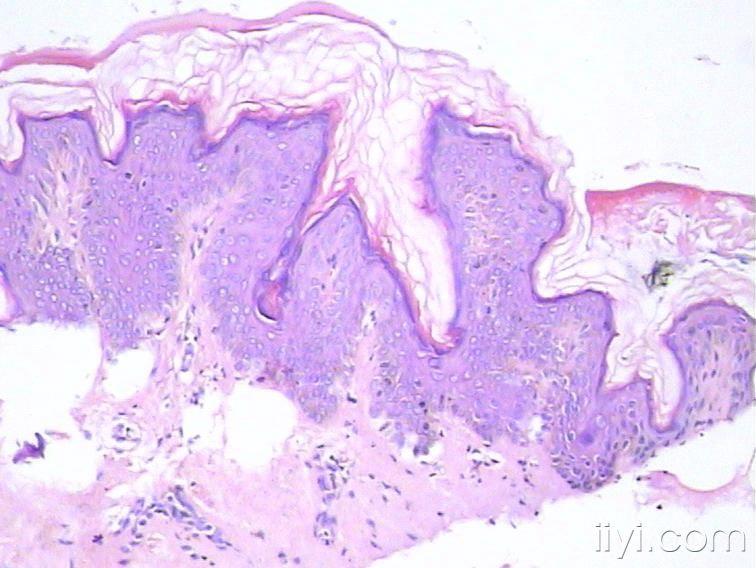 角化性丘疹可怜的家庭到底患了什么病附病理