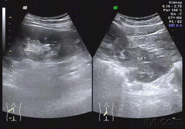 也发两张融合肾(马蹄肾)与各位共享 超声医学讨论版 爱爱医医学
