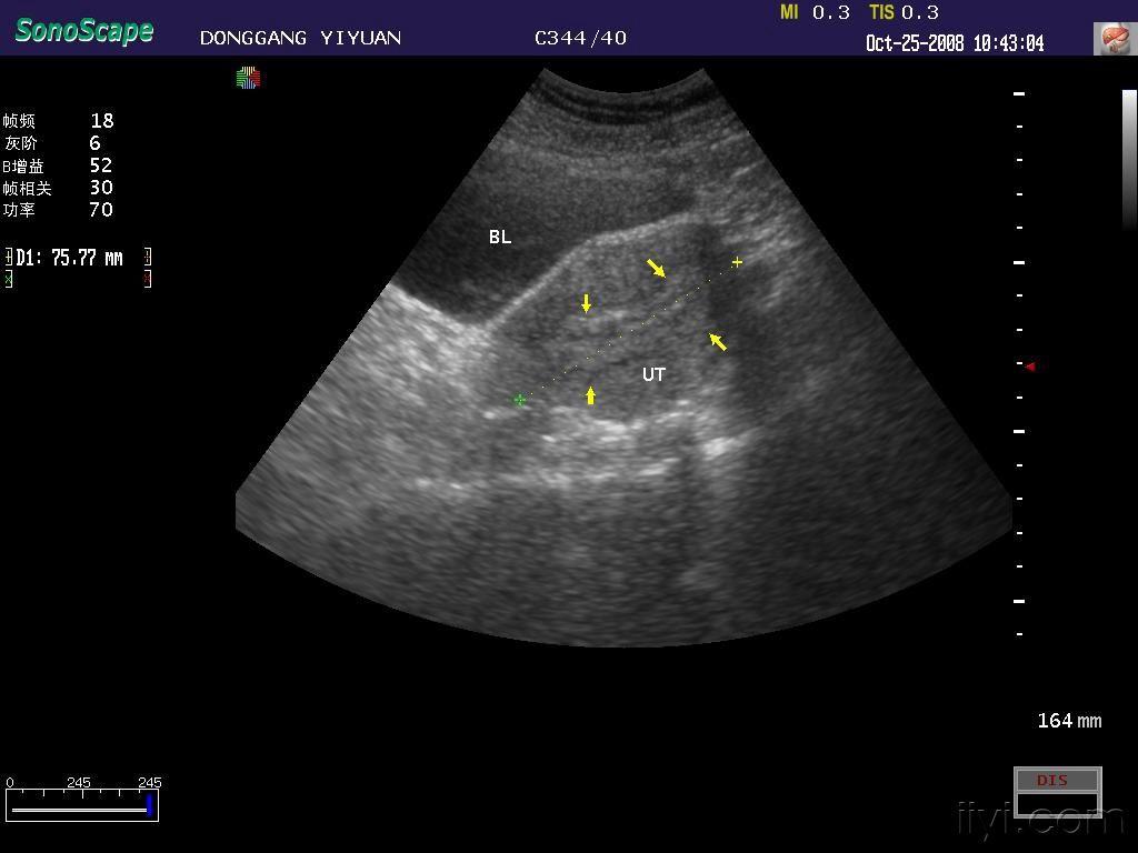 双角子宫 - 超声医学讨论版 - 爱爱医医学论坛
