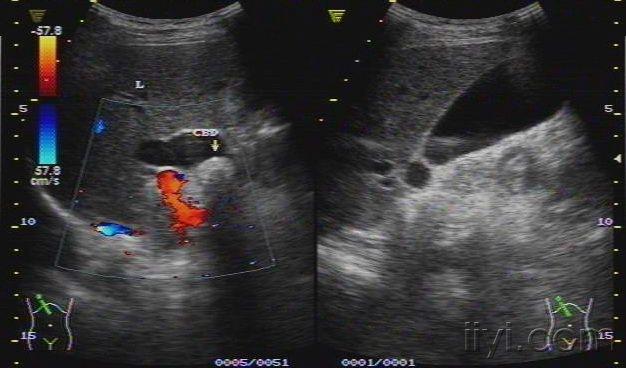 典型的肝内外胆管结石 - 超声医学讨论版 - 爱爱医
