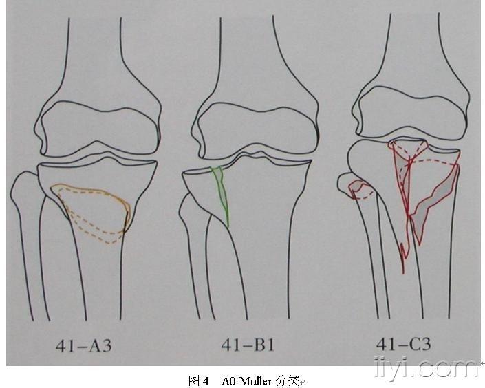 【专题讲座】胫骨平台骨折的外科治疗!