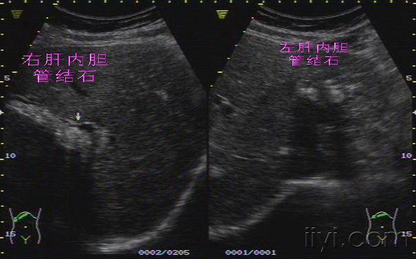 典型的肝内外胆管结石 - 超声医学讨论版 - 爱爱医医学论坛