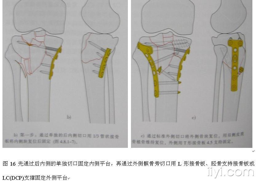 【专题讲座】胫骨平台骨折的外科治疗!