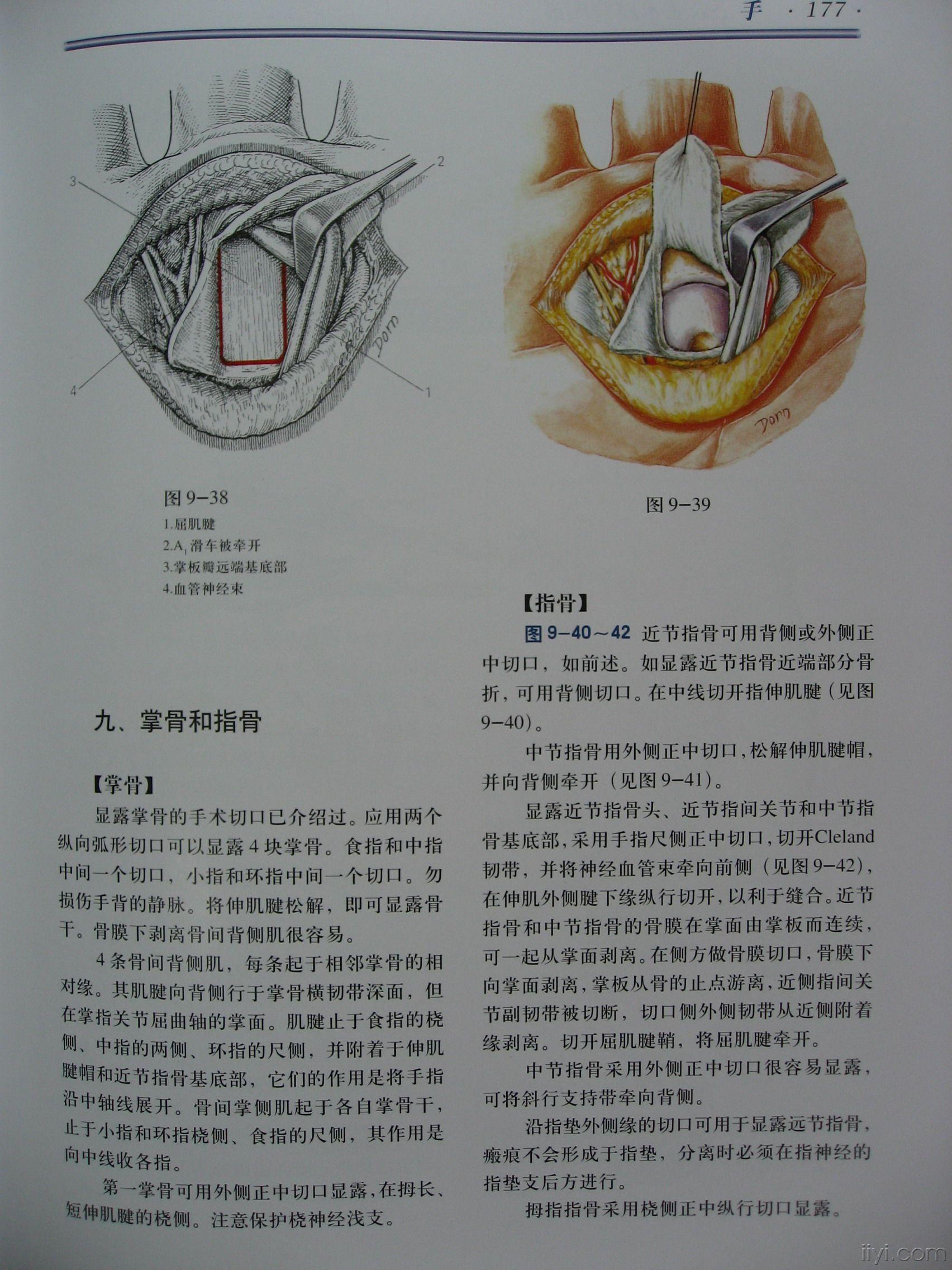 第五掌骨骨折手术入路