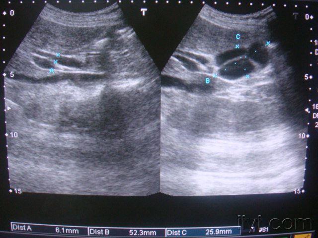 和副脾! - 超声医学讨论版 - 爱爱医医学论坛