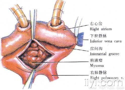 续心房粘液瘤手术过程