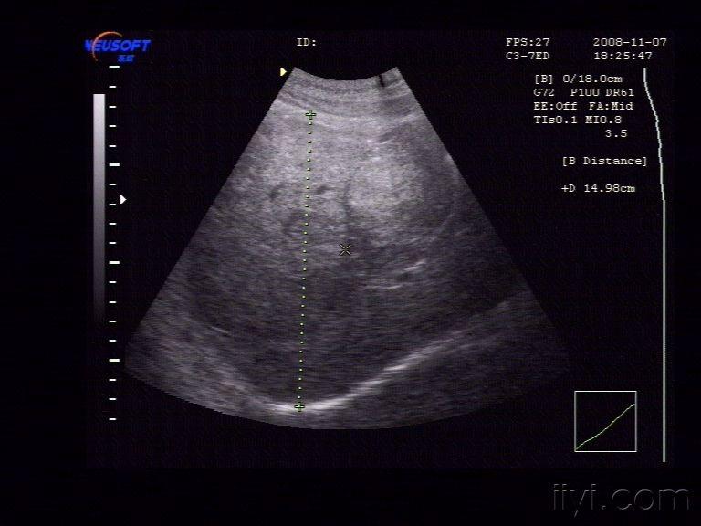 超声可见:   肝脏增大,右肝斜径150mm,包膜完整,表面光滑,肝区光点