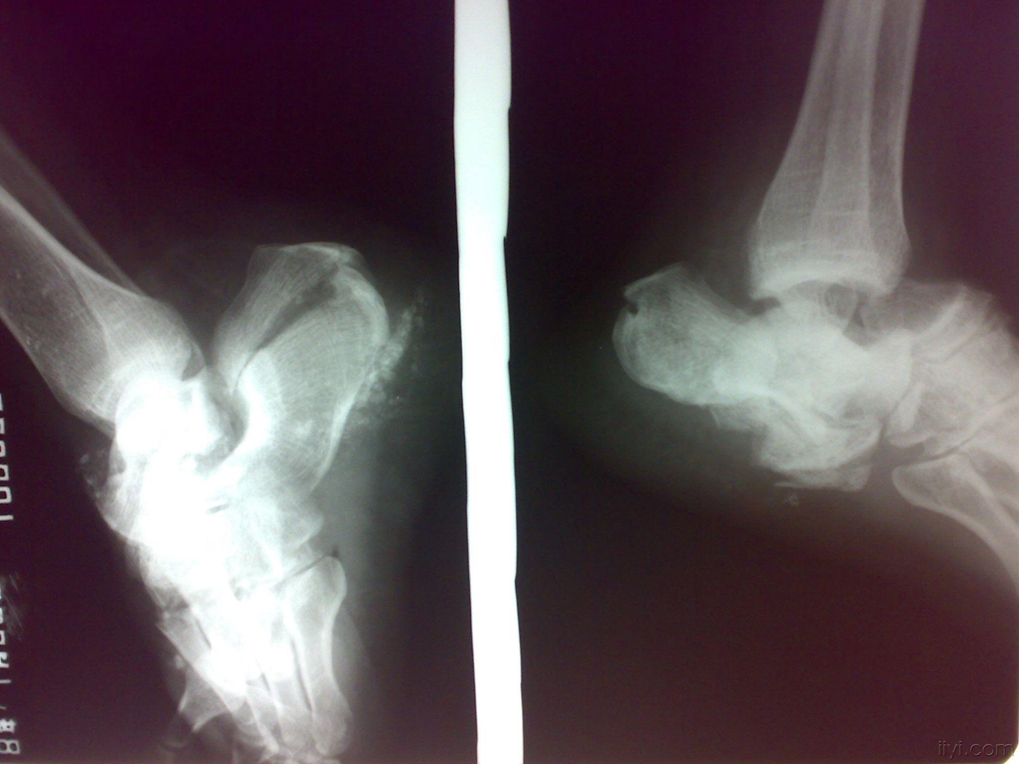 病例讨论踝关节和平台骨折