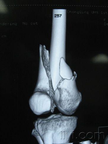 病例讨论股骨髁间粉碎性开放性粉碎性骨折原创