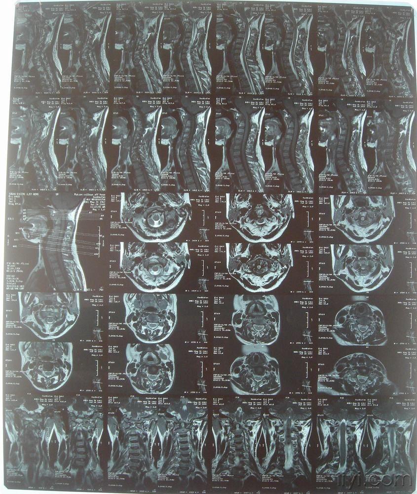 颈椎mri