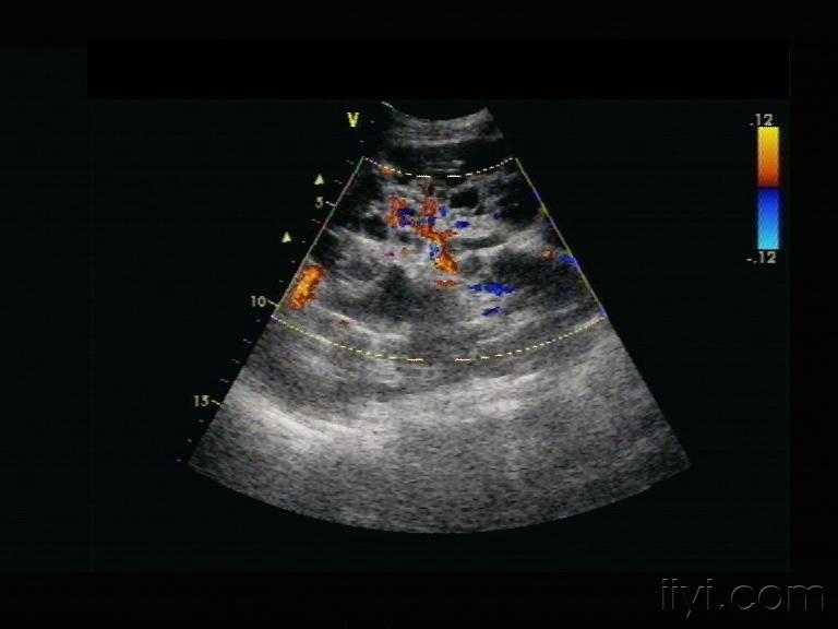 肾实质回声增强; 多囊肾与多发性肾囊肿鉴别诊断:前者肾实质完全被