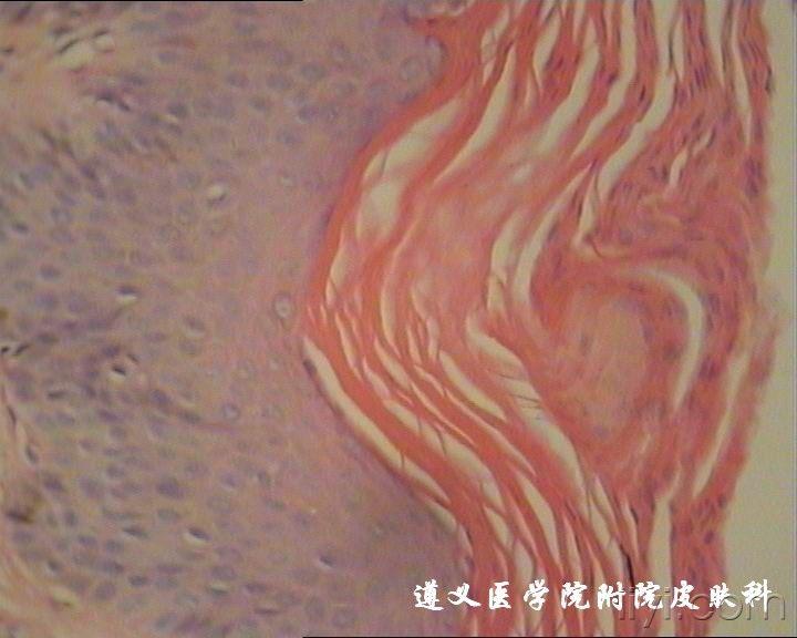 [皮肤病] 毛发红糠疹
