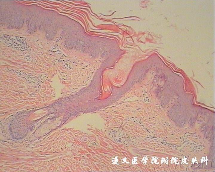 [皮肤病] 毛发红糠疹