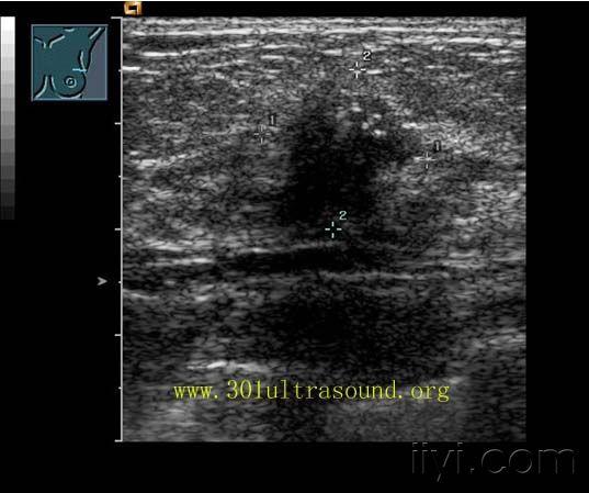 乳腺癌 - 超声医学讨论版 - 爱爱医医学论坛