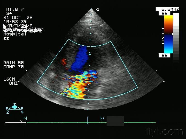 二尖瓣脱垂图像