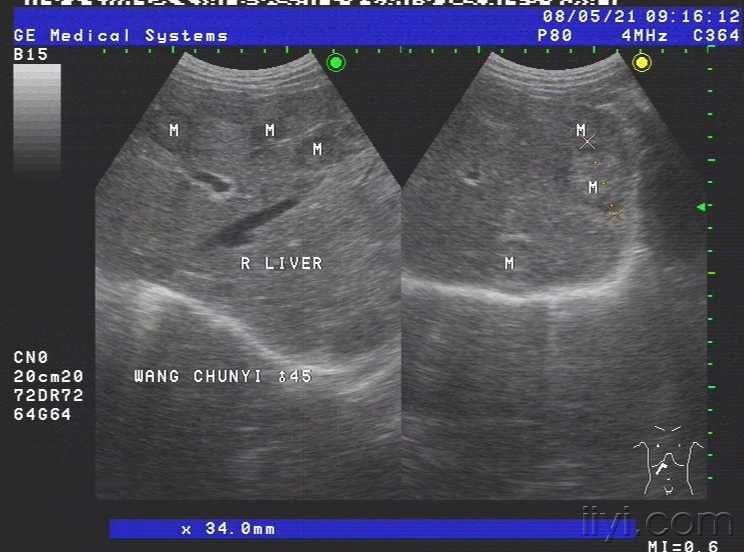 肝癌- 超声医学讨论版 - 爱爱医医学论坛