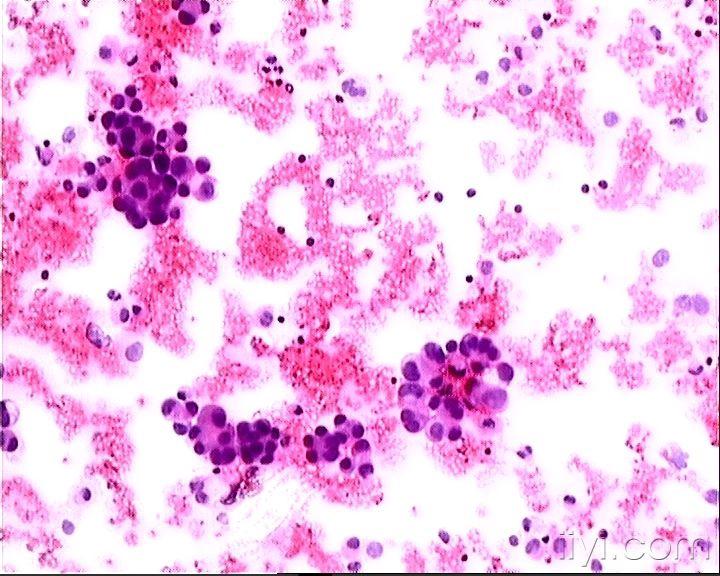 寻找典型的胸腹水中典型的腺癌细胞图片
