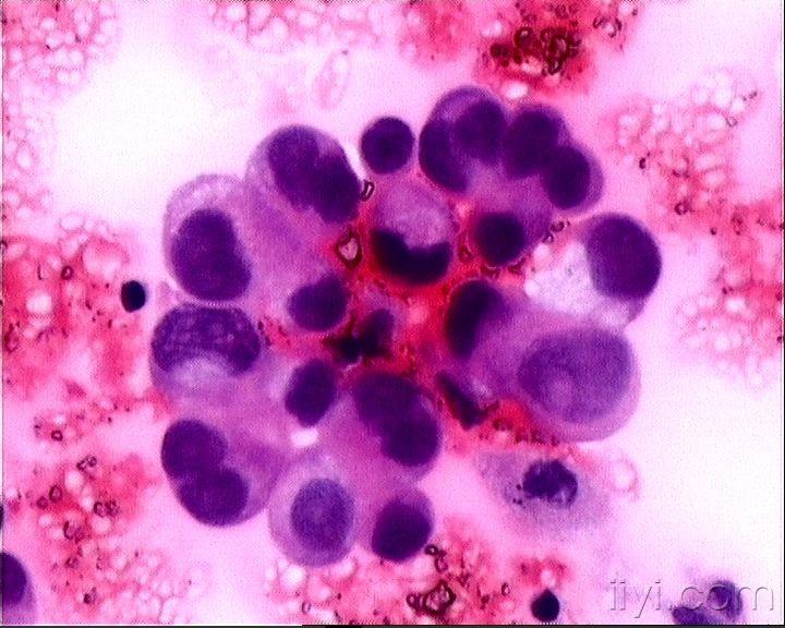 寻找典型的胸腹水中典型的腺癌细胞图片