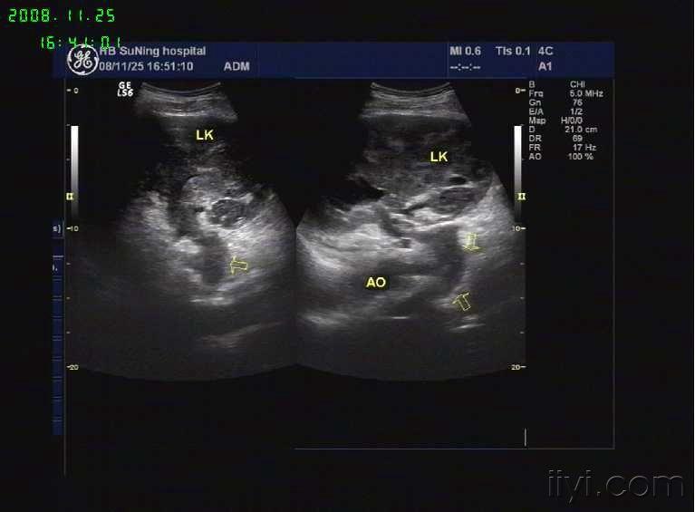 左肾静脉血栓形成 超声医学讨论版 爱爱医医学论坛