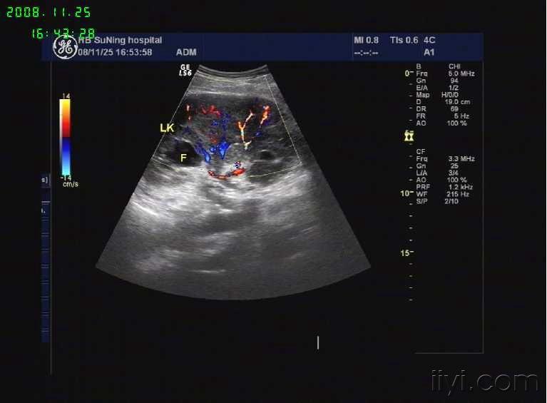 左肾静脉血栓形成 超声医学讨论版 爱爱医医学论坛