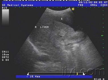 【讨论】肝硬化合并肝内多发实性团块及大量腹水