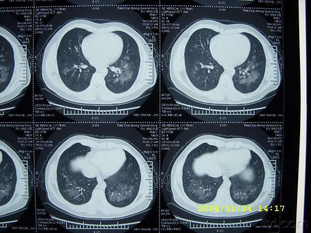 这样的肺ct影像能考虑什么?