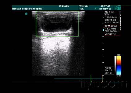 43岁女性,颈部正中包块,甲状腺舌骨囊肿;   一点知识:甲状腺舌骨