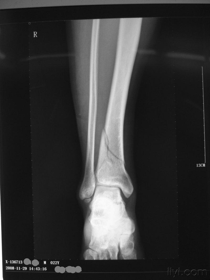 右胫骨下段骨折伴后踝骨折
